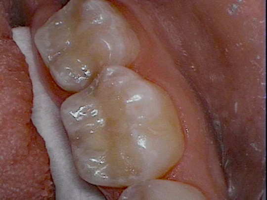 Amalgam to Resin Fillings After