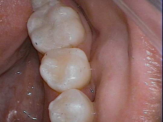 Amalgam to Resin Fillings After