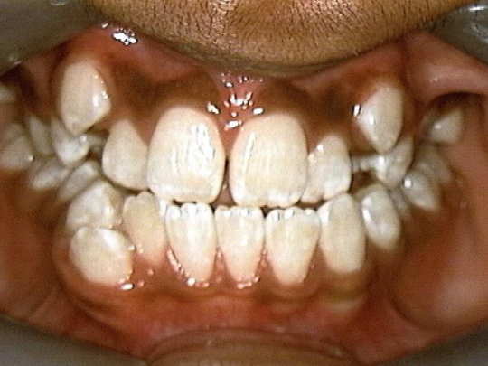Orthodontics Before