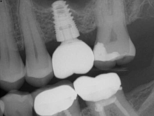 Single Implant After